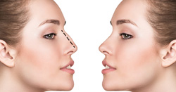 acide hyaluronique tunisie tunisie,blépharoplastie Tunisie,chirurgien esthetique tunisie,chirurgien esthetique paris,chirurgien esthetique Tunisie,paris 75 acide hyaluronique tunisie,toxine botulique tunisie,Tunis,injection acide hyaluronique visage tunisie