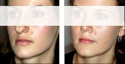 chirugie esthetique menton 91 génioplastie pas cher 91,meilleur chirurgien 7700