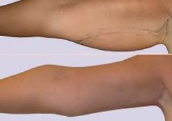 chirugie esthetique menton paris,brachioplastie paris,brachioplastie 75,brachioplastie 75 paris,brachioplastie paris,brachioplastie tunisie lifting bras pas cher paris,meilleur chirurgien 7700