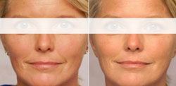 lifting visage prix mougins,lifting cervico facial mougins