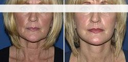 lifting visage pas cher antibes,meilleur chirurgien 6600