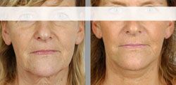 lifting visage antibes,lifting cervico facial 6600