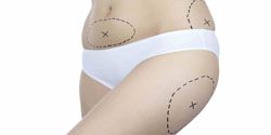 lipofine silhouette villeneuve-loubet,liposuccion anches 6270