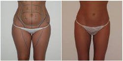 liposuccion pas cher talence,meilleur chirurgien talence