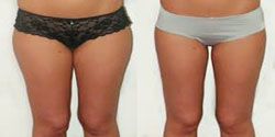 chirurgien esthetique cuisse,ventre avignon,anches avignon,liposuccion complete avignon,culotte de cheval avignon