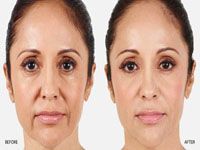 augmentation mammaires avignon,lifting des seins avignon,lipofilling mammaire avignon,réduction mammaire {84000,gynécomastie 84000