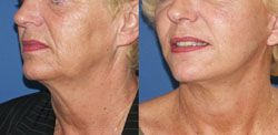 lipofilling visage 95240 cormeilles-en-parisis lipofilling visage prix 95240,lipofilling visage 95240