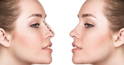 lipofilling visage 95240,lipofilling visage 95240 cormeilles-en-parisis,chirurgien esthetique tunisie,chirurgien esthetique paris,chirurgien esthetique 95240 cormeilles-en-parisis,paris 75 chirurgie esthetique tunisie,chirurgie esthetique paris,val d oise,chirurgie esthetique 95240 cormeilles-en-parisis