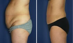 abdominoplastie prix 77360,abdominoplastie 77360