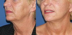 lifting cervico facial 77400,lifting cervico facial thorigny-sur-marne