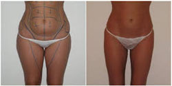 liposuccion pas cher 77720,meilleur chirurgien 77720