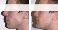 rhinoplastie 77260,rhinoplastie la-ferte-sous-jouarre