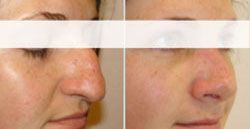 rhinoplastie pas cher 77500,meilleur chirurgien77500