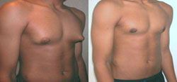 gynécomastie prix 78300,gynecomastie homme 78300,gynecomastie homme poissy,gynecomastie poitrine homme 78300,gynécomastie 78300