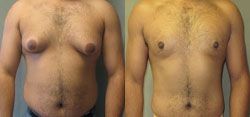 gynécomastie 78520,gynecomastie homme 78520,gynecomastie homme limay,gynecomastie poitrine homme 78520,gynécomastie limay