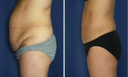 abdominoplastie prix 91,abdominoplastie 91
