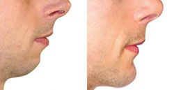 chirurgien esthetique menton 91