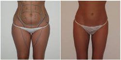 lifting cuisses pas cher 91,meilleur chirurgien 91