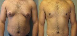 gynécomastie 92500,gynecomastie homme 92500,gynecomastie homme rueil-malmaison,gynecomastie poitrine homme 92500,gynécomastie rueil-malmaison