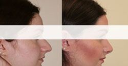 rhinoplastie prix 92,rhinoplastie 92