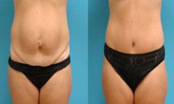 abdominoplastie tunisie