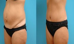 lifting ventre,abdominoplastie