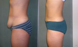 abdominoplastie tunisie pas cher