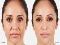 liposuccion tunisie,lifting des bras tunisie,lifting des cuisses tunisie,mini lifting abdominal tunisie,abdominoplastie tunisie,77,78,91,92,93,94,95