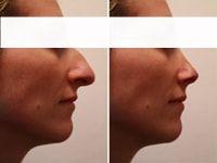 chirurgien esthétique tunisie pour une rhinoplastie